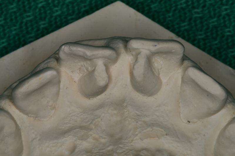 Mx Occlusal Close-up AE.jpg